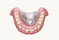 チタン製義歯