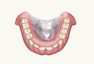 コバルト製義歯