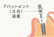 インプラント２次オペ