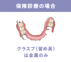 保険診療の場合 クラスプ（留め具）は金属のみ