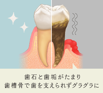 歯石と歯垢がたまり歯槽骨で歯を支えられずグラフラに