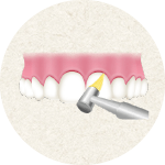 歯間や歯面をクリーニング
