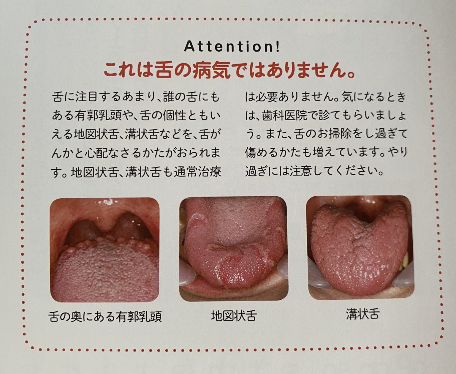 ベロがヒリヒリ? |高石市の歯科 なないろの森歯科クリニック ベロがヒリヒリ? |高石市の歯科 なないろの森歯科クリニック
